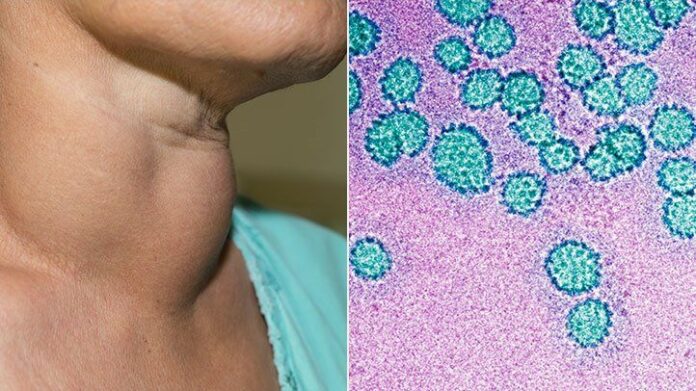 sexually-transmitted-infection-rise-in-neck-cancers-722x406